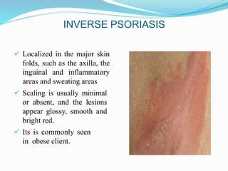 Psoriasis Ppt