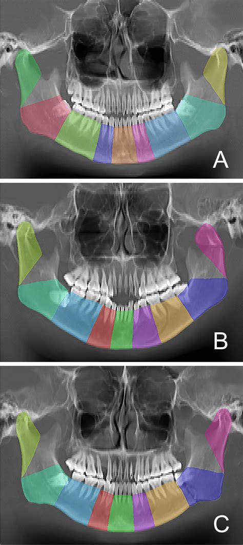 Annotation of the mandibular subregions. A Mandibular symphysis ...