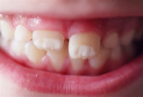 White Spots On Teeth Serenity Clinic Dubai Marina