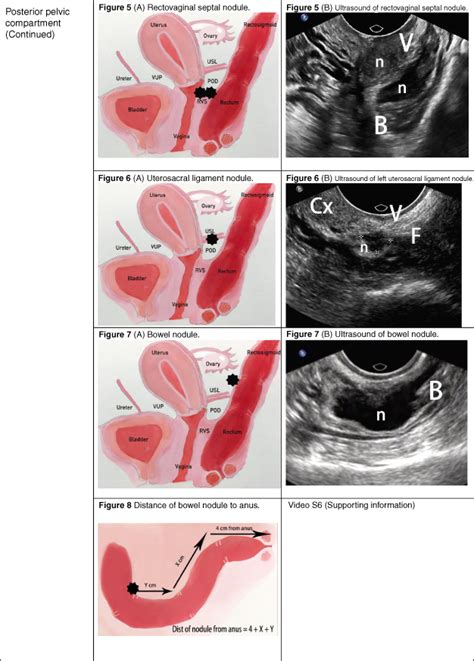 A Step‐by‐step Guide To Sonographic Evaluation Of Deep Infiltrating