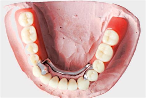 Protezy Ruchome Jakie Wybra Szkieletowe Bezklamrowe Osiadaj Ce