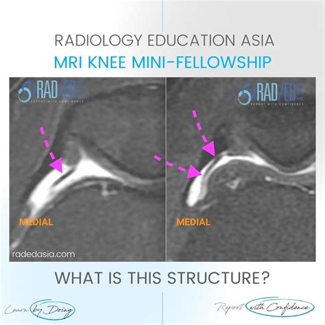 Knee Anatomy Plica