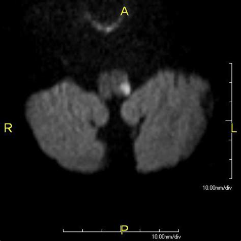 Wallenberg Syndrome - Physiopedia