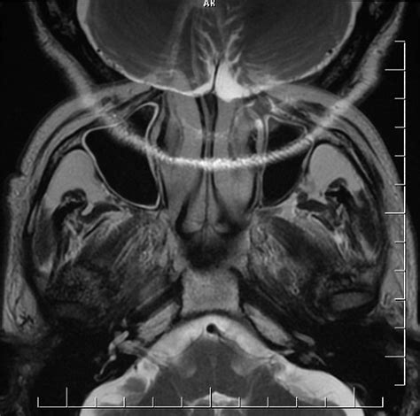 Aliasing In MRI Pacs