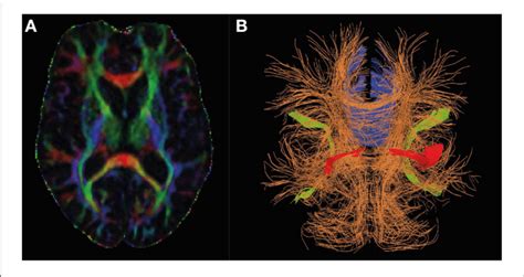 Diffusion Tensor Mri In Alzheimer S Research Panel A Shows The