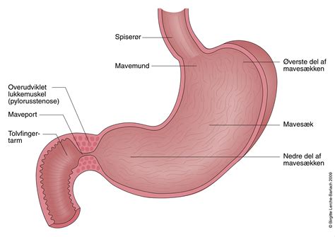 Pylorusstenose Patienthåndbogen på sundhed dk