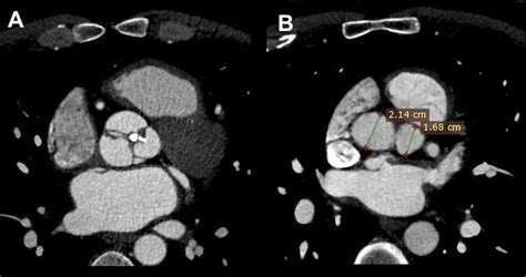 Estenosis Aórtica Supravalvular Cuerda Aórtica