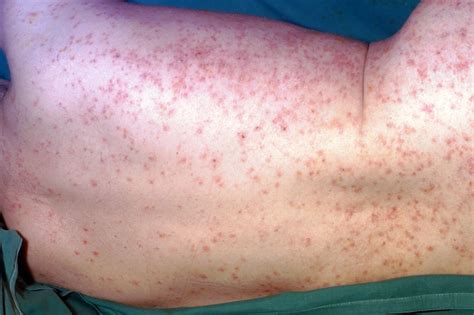 Hiv Aids Rash Pictures Symptoms And Treatment