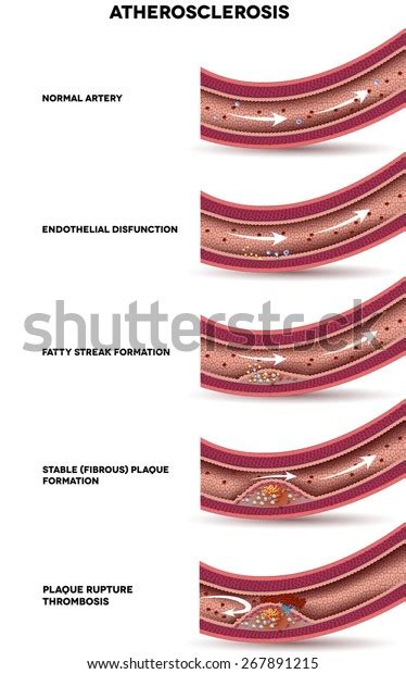 Atherosclerosis Detailed Illustration Atherosclerosis Stages Artery