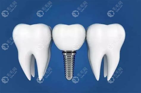 韩国dio种植牙价格多少网传韩国迪奥种植牙3800靠谱吗 口腔健康 毛毛网