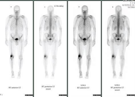 Whole Body Tc M Bone Scan Showed Isolated Increased Activity In The