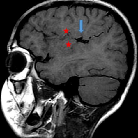 The Sagittal Section Of A T1 Sequence Mri Showing Shows Perisylvian