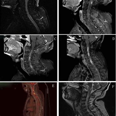 MRI of cervical spinal cord demonstrated multiple lesions with occupied ...