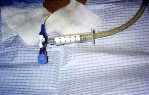 Large Volume Paracentesis A Fast Convenient And Safe Technique