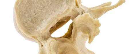 mri study finds lumbar dural sac volume expands  ivd  standing