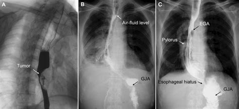 Upper Gastrointestinal Contrast A Preoperative Photograph Shows The