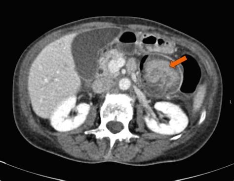 Colocolic Intussusception In An Adult Eurorad