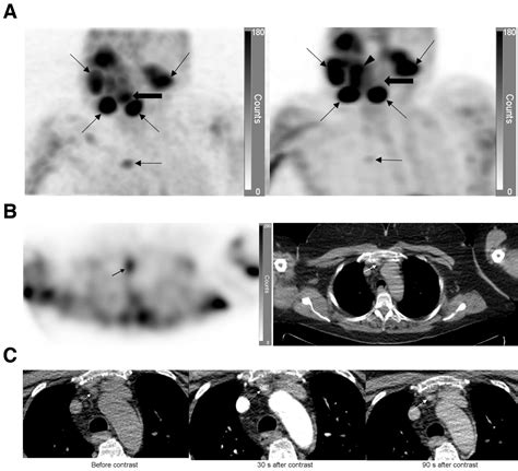 Synchronous Ectopic Thyroid Gland And Ectopic Parathyroid Adenoma On