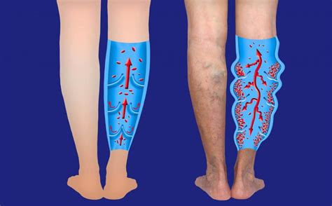 What You Need To Know About Venous Insufficiency El Paso Tx