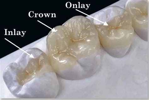 What is the difference between an onlay and an inlay?