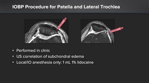 Arthrex In Clinic Intraosseous Bioplasty Iobp Treatment Of Severe