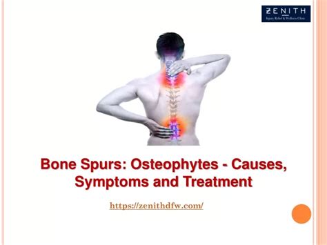 Ppt Bone Spurs Osteophytes Causes Symptoms And Treatment