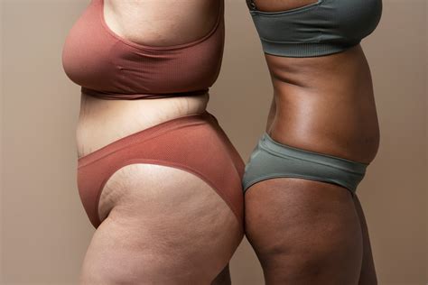 Lipedema cos è come si manifesta e si cura Salute che fare