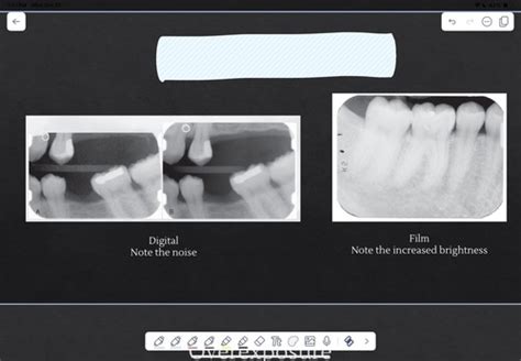 Oral Radio Landmarks On Maxilla And Mandible And Xray Errors Flashcards