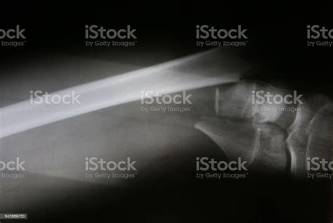 Xray Photos Of Bone Fracture Patients Stock Photo - Download Image Now ...