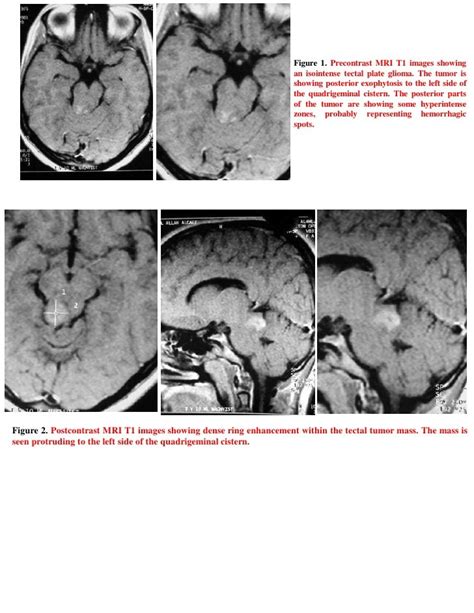 Short Casetectal Plate Glioma