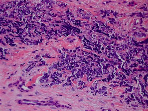 Merkel Cell Carcinoma Pathology / Merkel Cell Carcinoma And Metastatic And Sarcomatoid ...