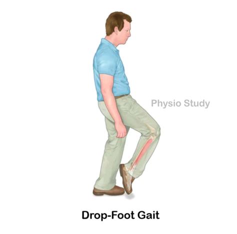 Motor Control Abnormal Mobility Flashcards Quizlet