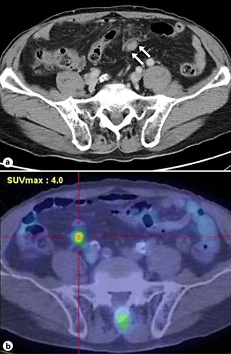 Enlarged Lymph Nodes In Abdomen