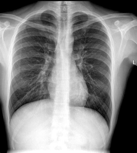 Anterior Posterior Chest X Ray Sexiz Pix