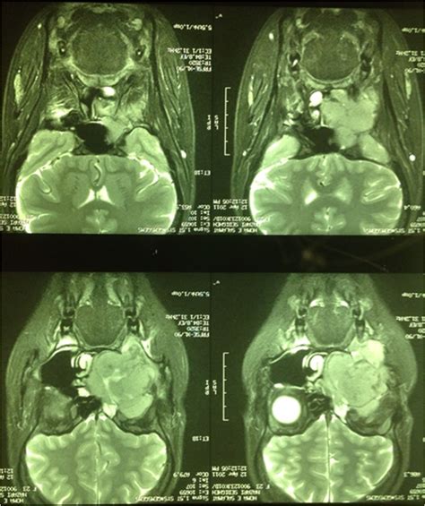 Figure 1 A Localized Heterogenous Mass In The Right Maxillary Sinus In The Diagnosis