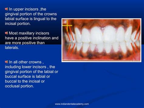 Andrews Six Keys Of Occlusion Certified Fixed Orthodontics Courses In