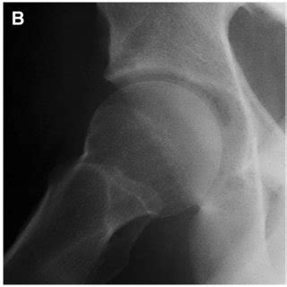 Anterior Posterior And Frog Leg Lateral Radiographs Of A Patient With