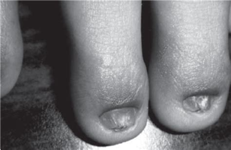 Hypodontia and Microdontia | Download Scientific Diagram