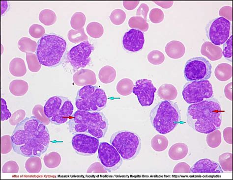 Pleomorphic Variant Cell Atlas Of Haematological Cytology