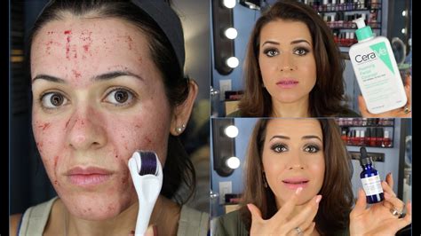 Derma Roller Antes E Depois - O Que Usar Depois Do Dermaroller - Lavra