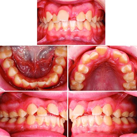 Pretreatment Photos Showing Space Loss Of Upper Left Central Incisor