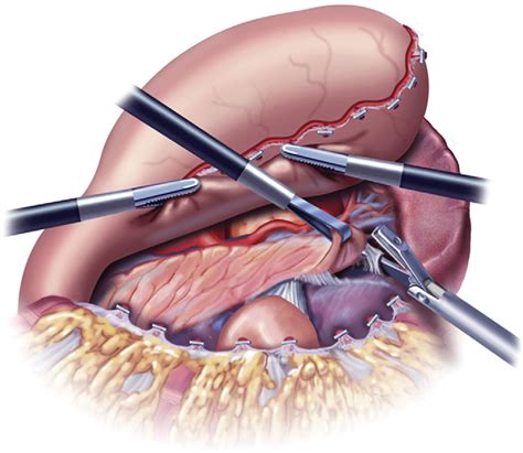 Distal Pancreatectomy