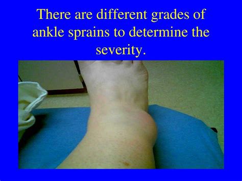 Ppt Ankle Sprains Powerpoint Presentation Free Download Id5492236