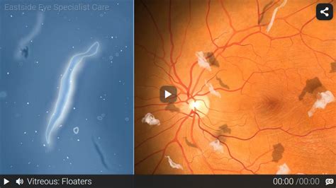 Posterior Vitreous Floaters