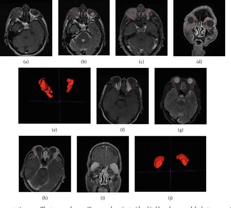 Figure From To Explore Mr Imaging Radiomics For The Differentiation