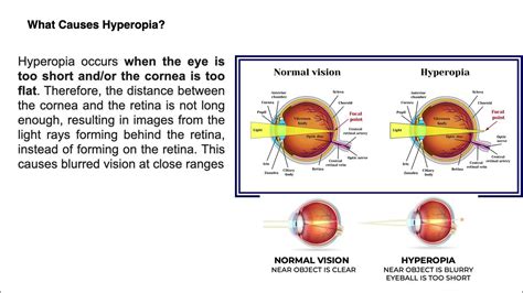 what causes hyperopia ? - YouTube