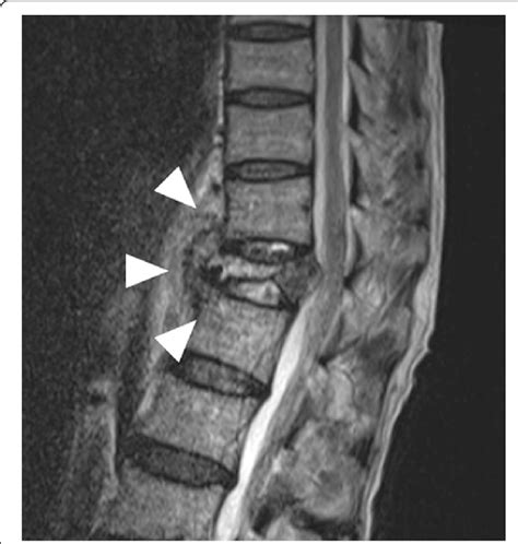 Lumbar Magnetic Resonance Imaging MRI On Admission MRI Revealed A