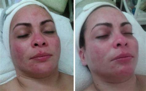 Rhinophyma Treatment Photos » Rhinoplasty: Cost, Pics, Reviews, Q&A