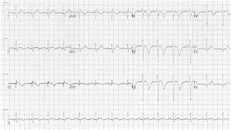 Identifying right ventricular failure