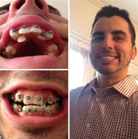 Before and after braces: Incredible Transformations of People Who Wore ...